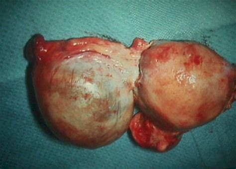 Ovarian Neoplasm
