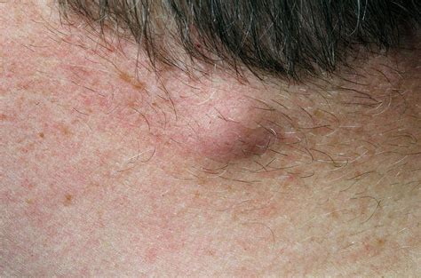 Sebaceous Cyst On The Neck Photograph By Dr P Marazziscience Photo Library