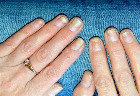 Fungal Nail Infection Onycholysis After Shellac Or Gel Varnish Stock