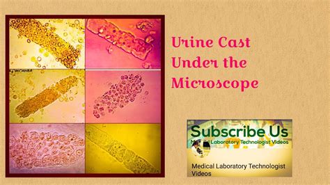 Urine Cast Types And Causes Urinanalysis Youtube