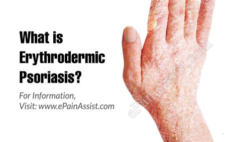 What Is Erythrodermic Psoriasis Causes Symptoms Treatment Prognosis