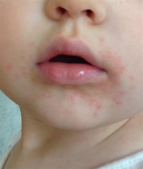 Baby Rash Around Mouth And Legs Get More Anythinks