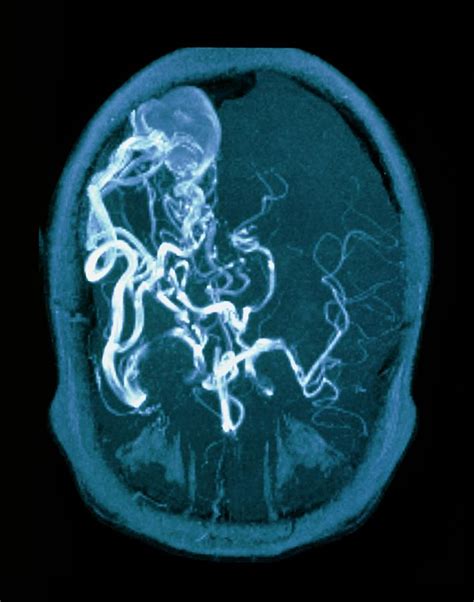 Mri Scan Of Brain With Arteriovenous Malfunction Photograph By Simon