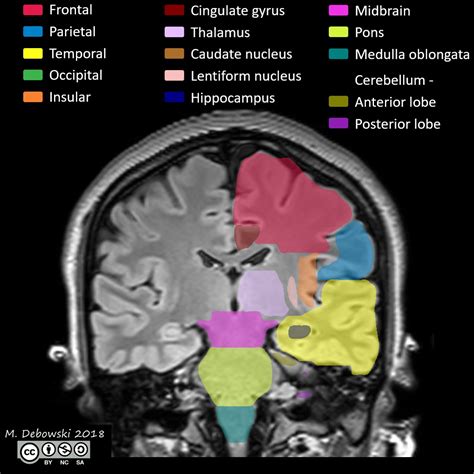 Brain Lobes Annotated Mri Image