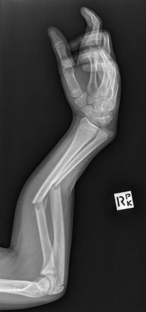 Ulna Bone Fracture