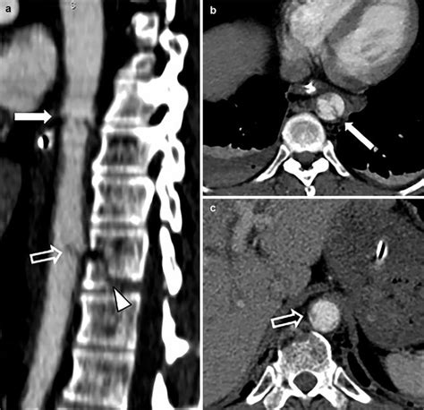 Traumatic Aortic Injury Radiology Key