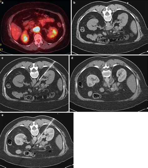 Ct Guided Biopsy Radiology Key