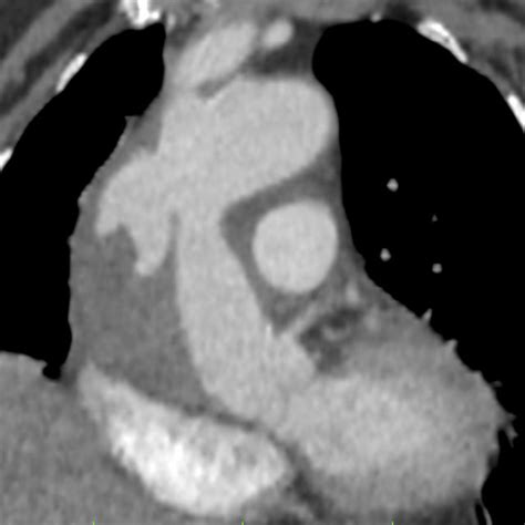 Computed Tomography Ct Showed A Large Dissecting Ascending Aortic