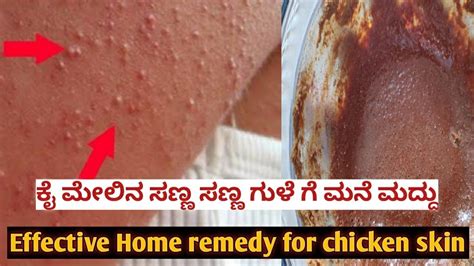 ನಿಮ್ಮ ತೋಳಿನಲ್ಲಿ ಇರುವ ಸಣ್ಣ ಸಣ್ಣ ಗುಳೆ ಗೆ ಮನೆ ಮದ್ದುhow To Get Rid Of