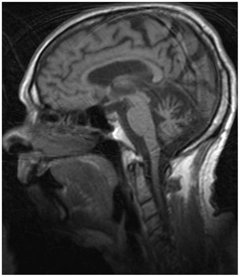 Brain Mri Of Patient Aiv 5 Showing Cerebellar Atrophy Download