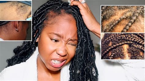 How To Get Rid Of Dandruff Dry Scalp Discoloration And Dry Patches Fast