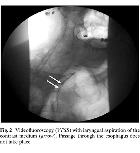 View Through A Wbre Optic Endoscopic Examination Of The Larynx The