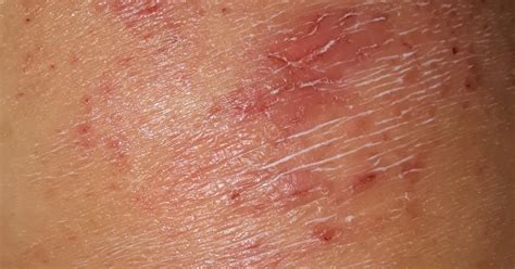 Dermatite At Pica Sampa Crian As Hot Sex Picture