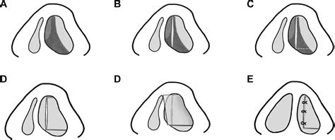 Fashioned Mucoperichondrium Flap Technique In Caudal Septal Deviation