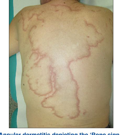 Figure 1 From Interstitial Granulomatous Dermatitis Due To Borreliosis