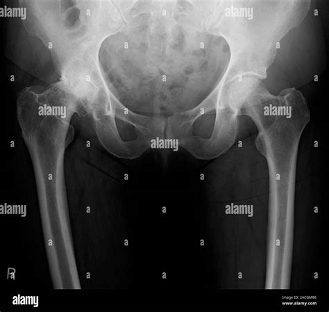 X Ray Front View Of The Pelvis In A 63 Year Old Female Patient