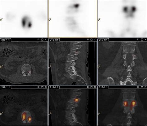 Il permet à votre médecin en plus d'autre examens comme la radiographie simple. Maladie de Paget, TEP FDG et Scintigraphie osseuse ...