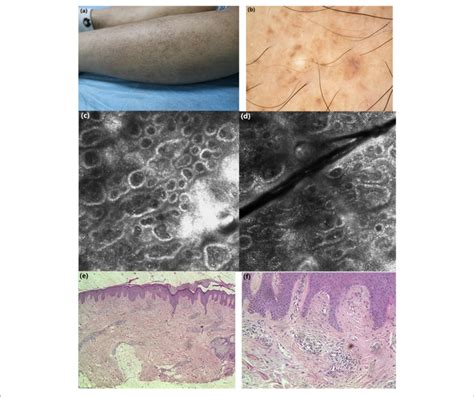 A Clinical Features Macular Hyperpigmentation In A Rippling