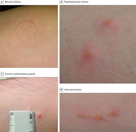 Cutaneous Lesions Due To Bites By Lone Star Ticks Allergy And