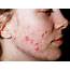 ACNE VULGARIS  Mobile Physiotherapy Clinic Ahmedabad Gujarat