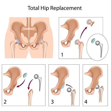 Revision Hip Replacement Neemtree Healthcare