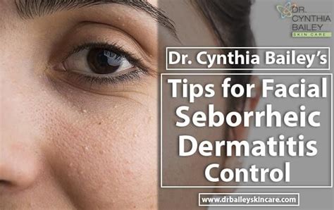Dr Cynthia Baileys Tips For Facial Seborrheic Dermatitis Control