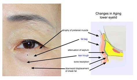 All About Eyebags The Aesthetic Studio Singapore Clinic And Surgery