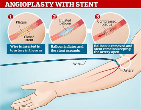 What Is A Stent And Why Would A Patient Get More Than One