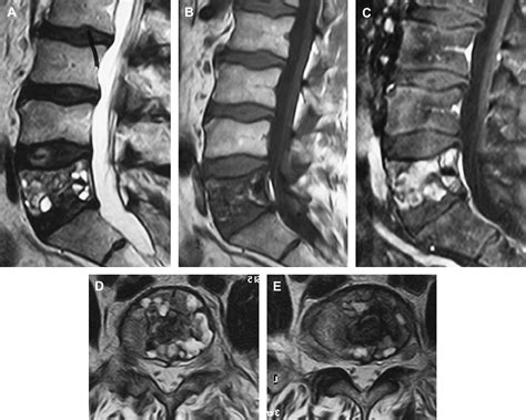 Aneurysmal Bone Cysts Of The Spine Neurosurgery Clinics