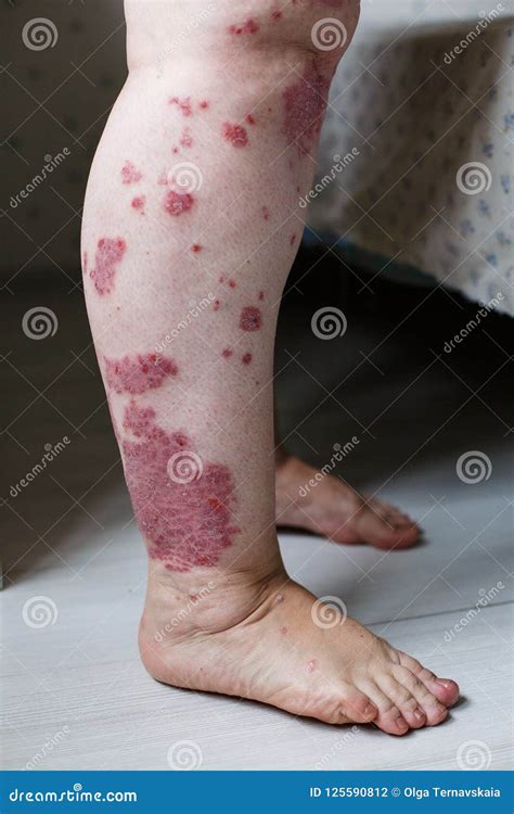 Close Up Dermatitis On Skin Ill Allergic Rash Dermatitis Eczema Skin