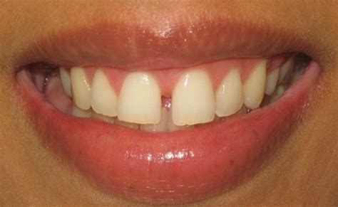 Teeth Gap Or Spaces Known As Diastema Shangrila Dental Clinic