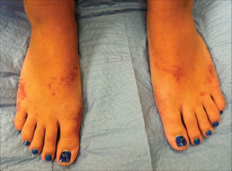 Purpuric Eruption On The Feet Of A Healthy Young Woman—quiz Case
