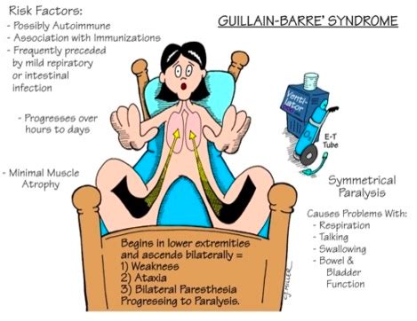 Nerve and damaged myelin sheath. Le syndrome de Guillain-Barré - Médecine Intégrée