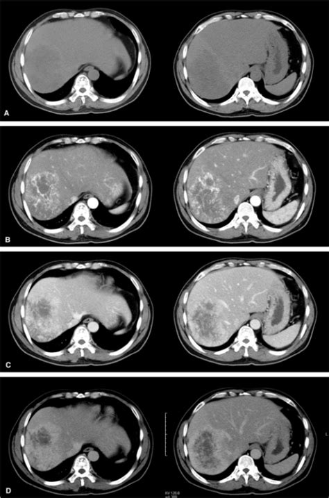 Dynamic Contrast Enhanced Ct Scans A Precontrast Ct Open I