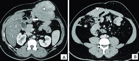 Axial Contrast Enhanced Ct Abdomen Of A 41 Year Old Male Diagnosed With