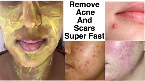 How To Get Rid Of Acne Scars Overnight Home Remedies Mang Temon