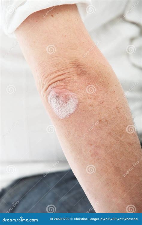 Psoriasis Skin Or Deciding On The Elbow Stock Image Image Of