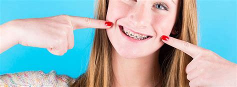 ¿cuánto Tiempo Dura Un Tratamiento De Ortodoncia Clínica Dental