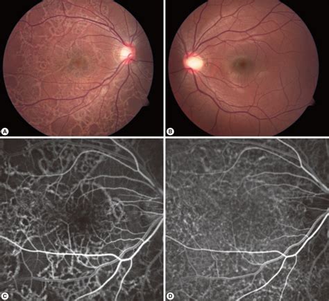 Fundus Photographs Of Both Eyes Of The Patient Fluorescein Angiography