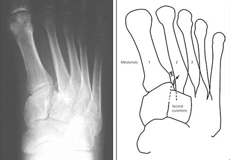 Diagnosis And Management Of Metatarsal Fractures Aafp