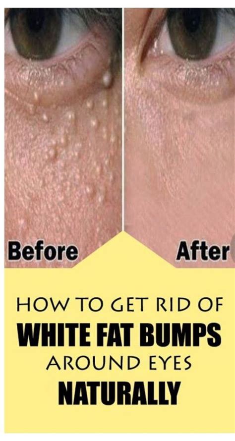 Remove Bumps Under Eyes Thefun