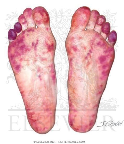 Purple Toe Syndrome Associated With Vitamin K Antagonist Therapy