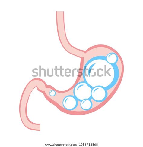 Medical Illustration Abdominal Bloated Stomach Transperant Stock Vector