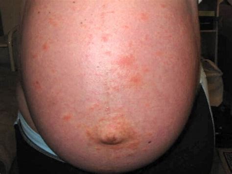Red Spots On Stomach During Pregnancy Not Itchy Your Red Itchy Bumpy