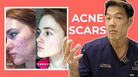 The Best Acne Scar Treatments Explained Dr Davin Lim Youtube