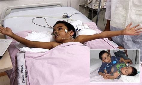 Conjoined Twin Survives Separation Operation Which Killed Brother In