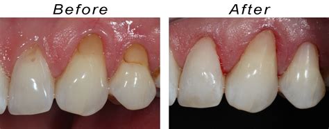 Filling Replacement Dental Filling Change Results