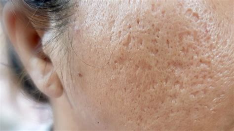 Types Of Acne Scars Pictures Of Boxcar Icepick Rolling And More