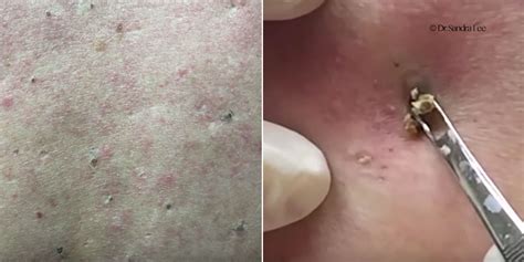 Watch Dr Pimple Popper Go To Town On This Minefield Of Back Blackheads