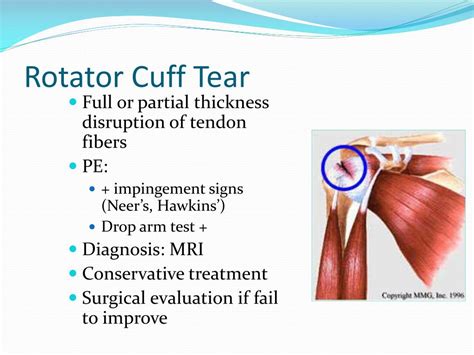 Degenerative Rotator Cuff Tear